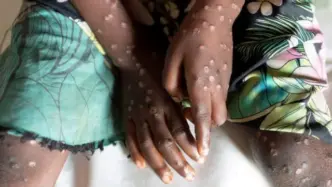 Africa No Longer Facing Mpox Emergency – Health Chief