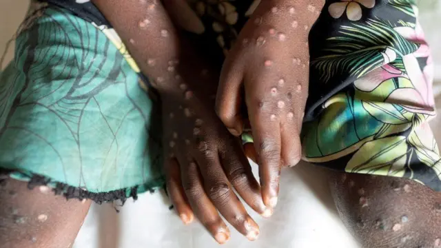 Africa No Longer Facing Mpox Emergency – Health Chief