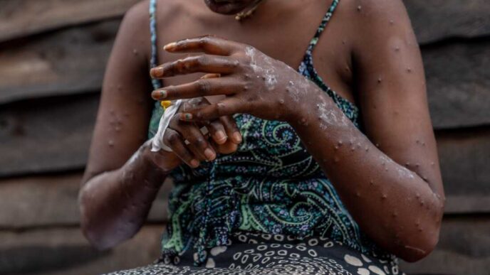 Ghana Reports 13 New Mpox Cases