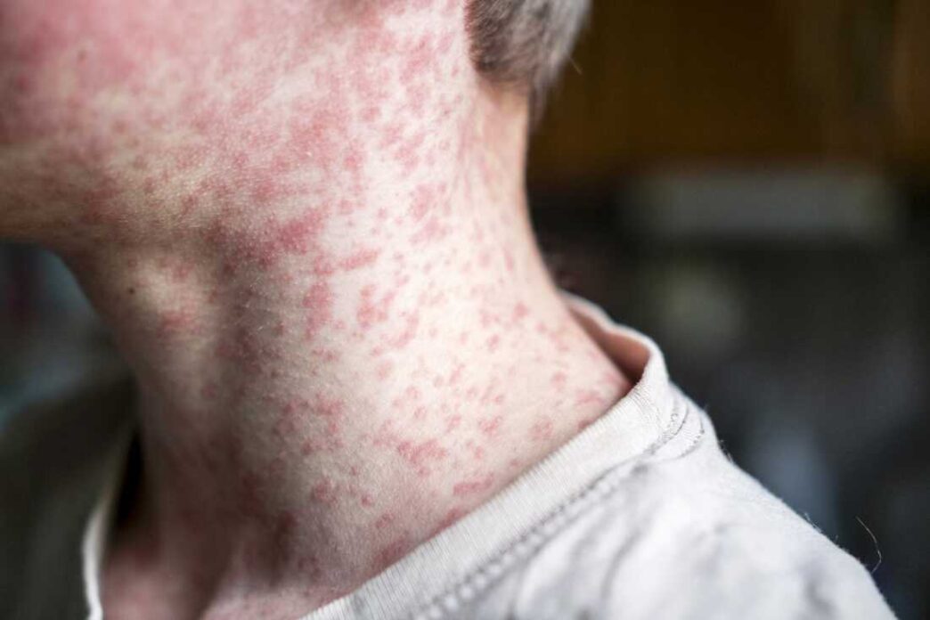 Vaccine Gaps Leave Bangladesh Exposed To Measles (News Central TV)