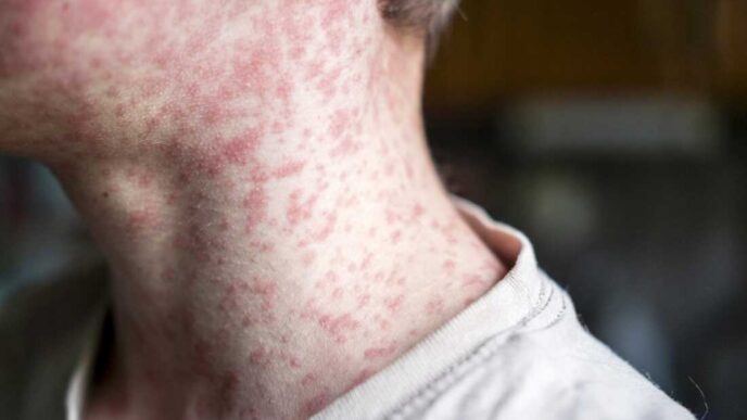 Vaccine Gaps Leave Bangladesh Exposed To Measles (News Central TV)